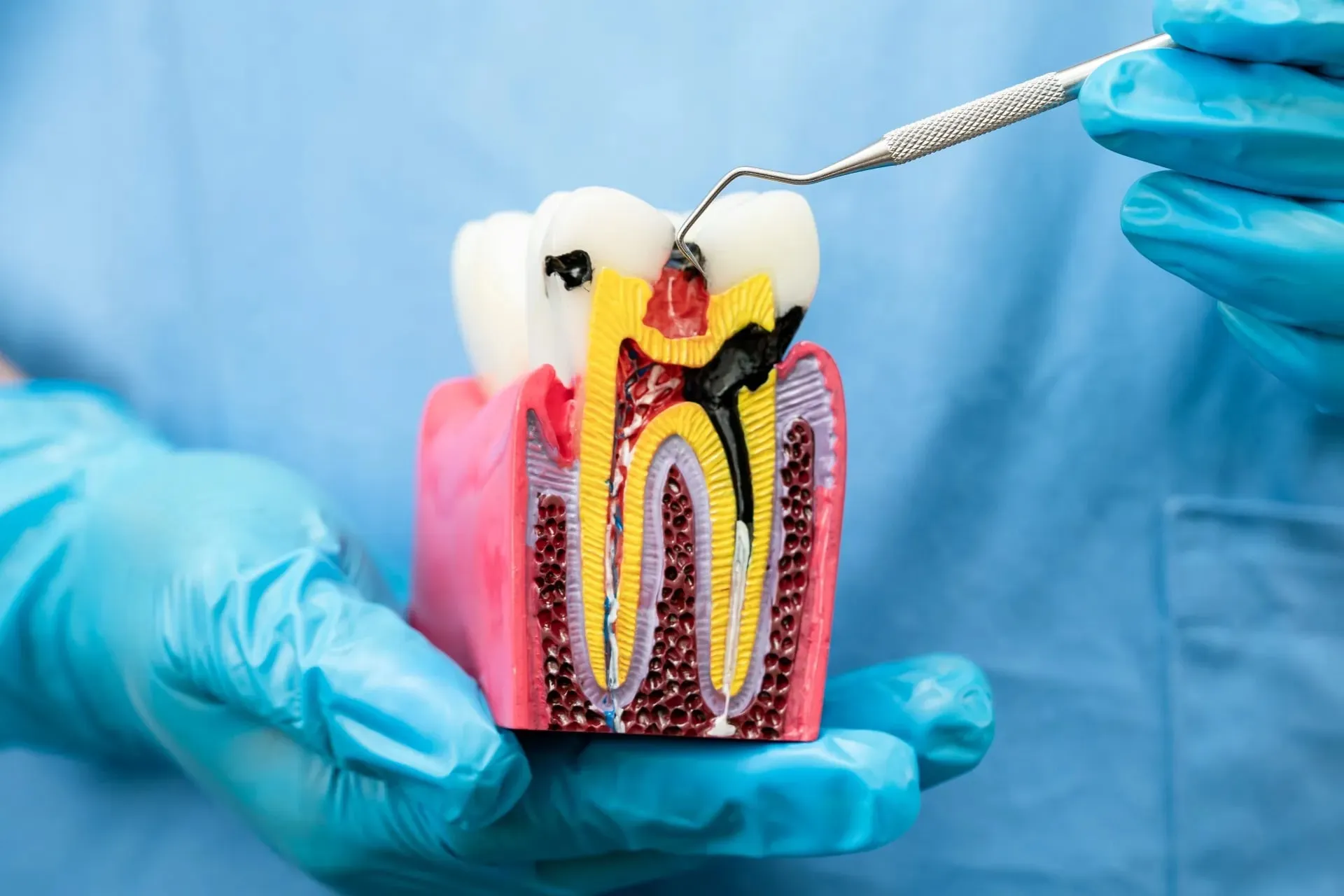 Root Canals — our approach