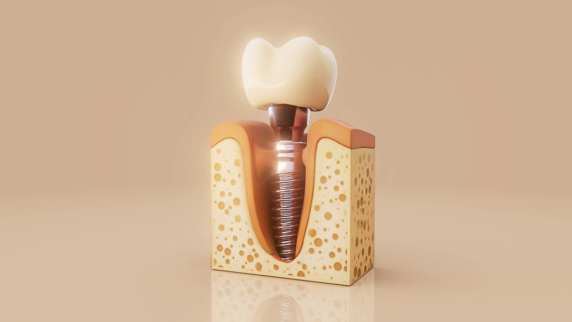 Dental Implants — our approach