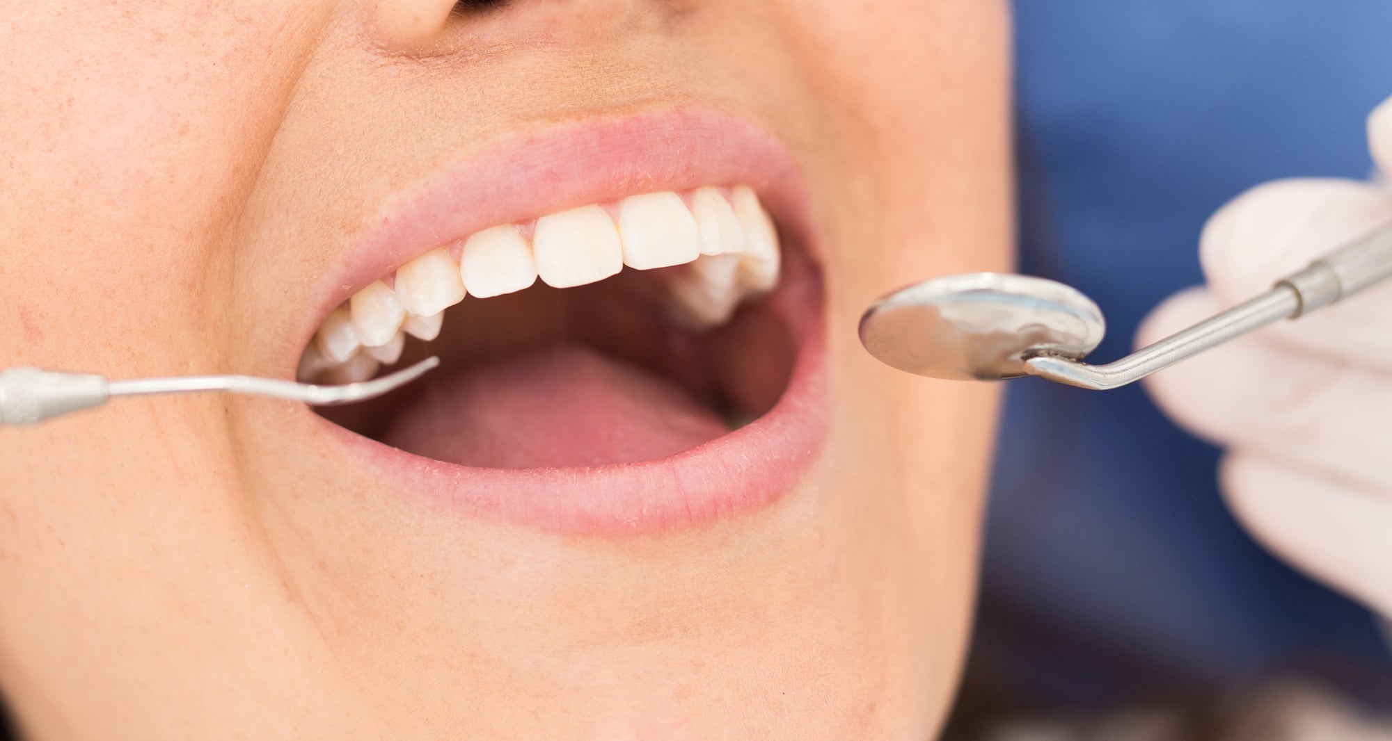 Composite Fillings — our approach