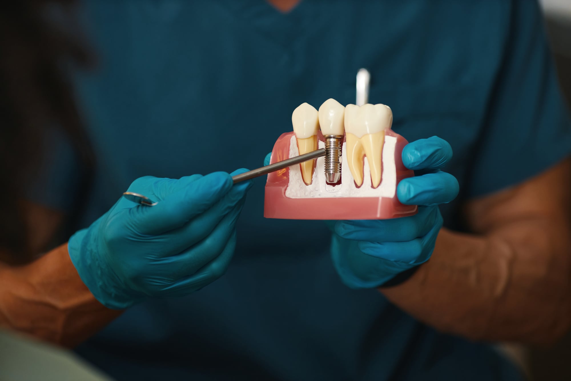 Dental Implants — what to know